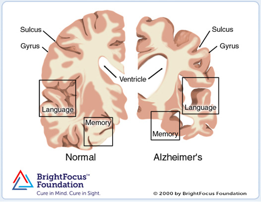 Medical illustration showing a brain with Alzheimer's disease