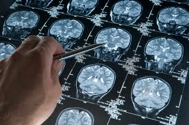 Unraveling the Mystery of Alzheimer's