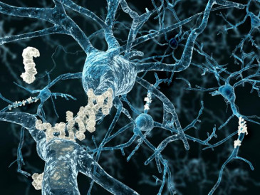 alzheimers amyloid plaques
