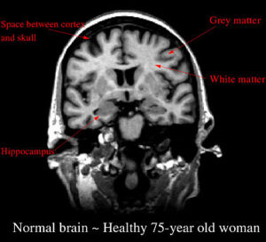 normal-aging
